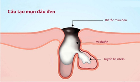 Cấu tạo mụn đầu đen